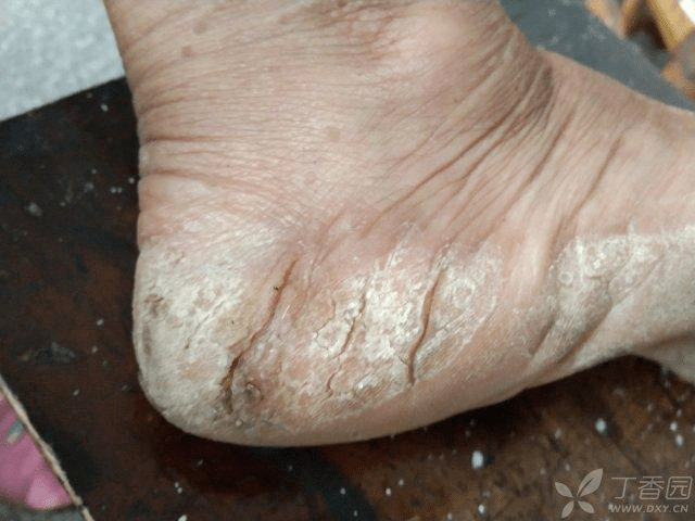 足癣,又称脚气,香港脚,运动员足,是最常见的浅部