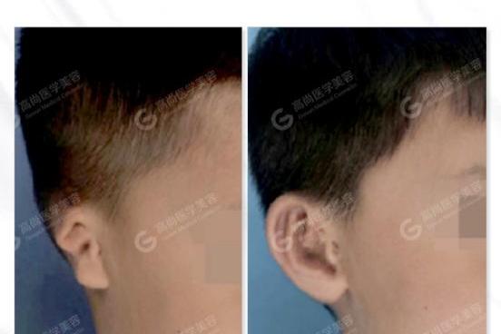 小耳畸形患者做耳朵再造整形手术前,这些准备工作必不可