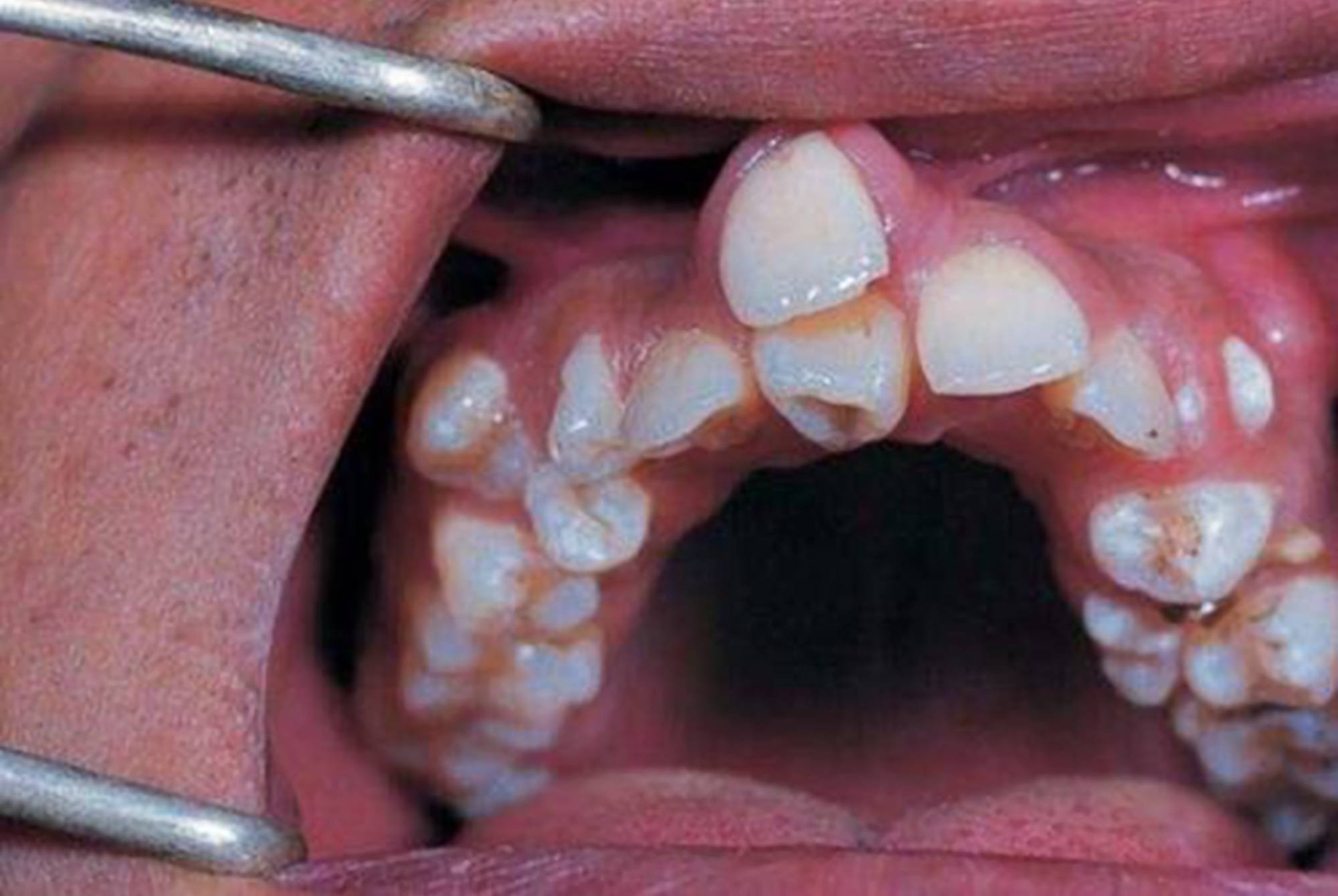 造成牙齿类的疾病