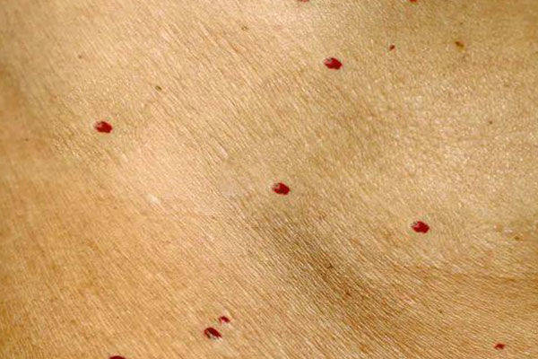 樱桃样血管瘤由局部血管增生引起,一般称为红痣或血管痣,是皮肤小红点