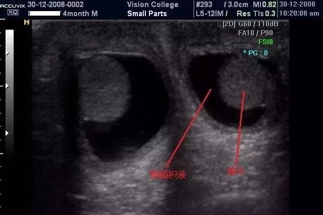 蛋蛋■谨防鞘膜积液杭州复旦儿童医：孩子蛋蛋变大
