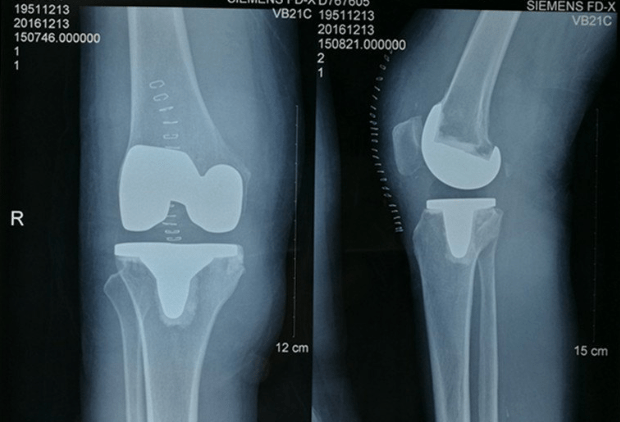 膝关节置换医院排名_膝关节置换图片