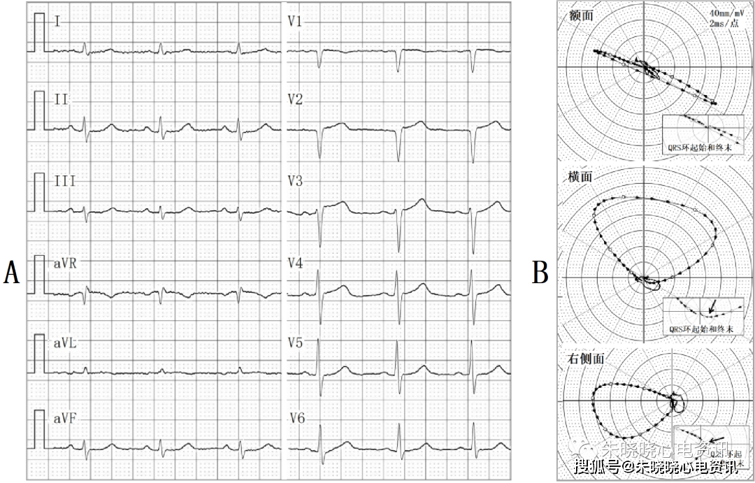 ecg轻度顺钟向转位(v1,v2呈qs型),vcg轻度右室肥大