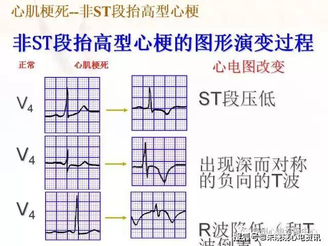 心肌缺血和心肌梗死的心电图改变ppt