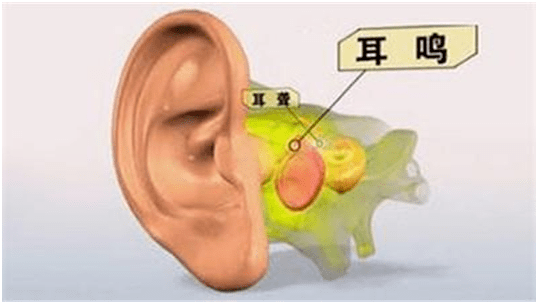 医患问答:耳聋,耳鸣为什么要做高压氧?