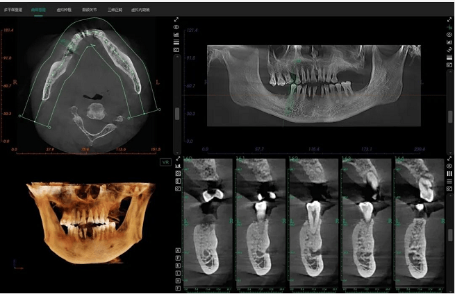 这台有"ai"的口腔cbct来了!