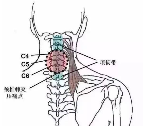 颈椎压痛点的检查