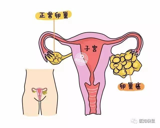 做好卵巢保养,你需要知道这5点