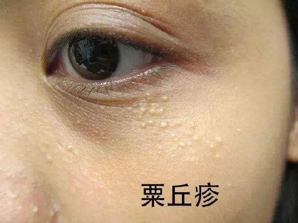 眼周长的上小颗粒是啥东西脂肪粒汗管瘤还是粟丘疹