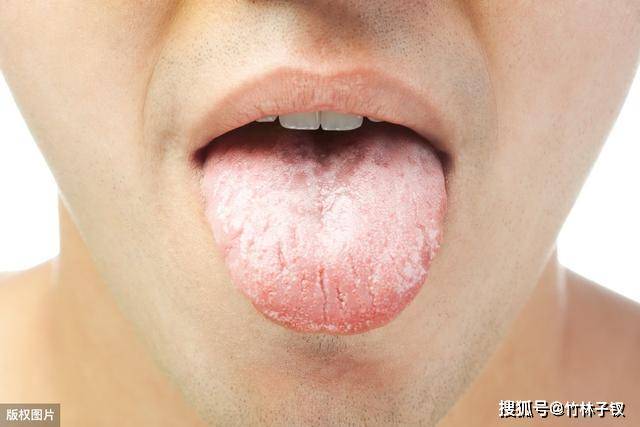 舌头上有这3"异常,预示胃已"瘫痪,尤其第3个胃癌已上门