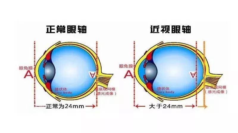 眼球较小,眼轴短且并未达到成人水平,正常的视网膜成像时眼轴长度大概