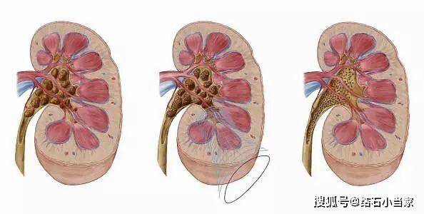 肾结石是由于什么导致的 cd887dfd61b24b9b944a7fbbb8c62430.jpeg