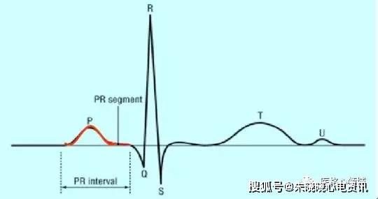 正常心电图波形及临床意义