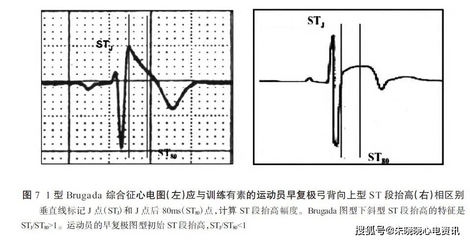 运动员心电图解析的国际建议