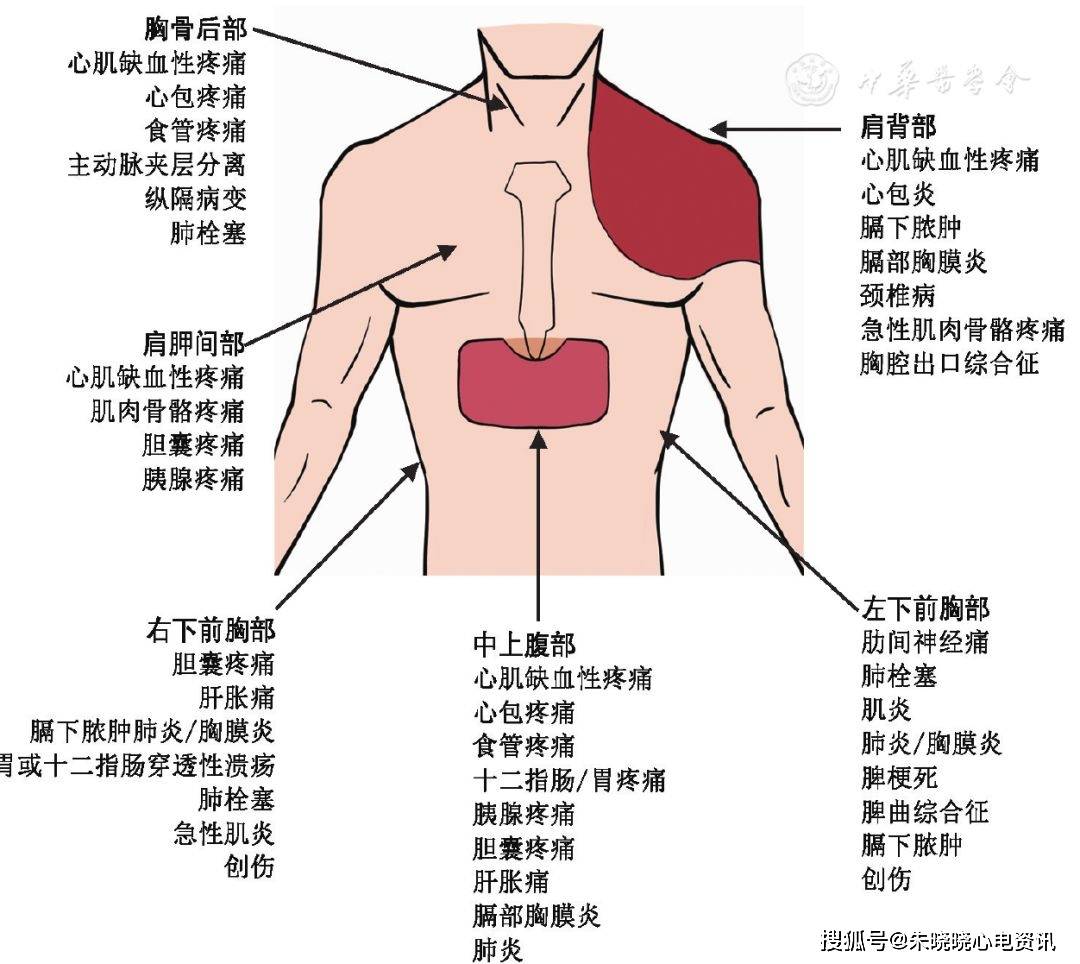 常见疾病及特点:    (1)稳定性心绞痛:典型的心绞痛位于胸骨后,呈憋闷