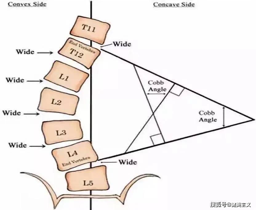 通过测量人体站立位正位 X线片的脊柱侧方弯曲角度,即cobb角 来确定