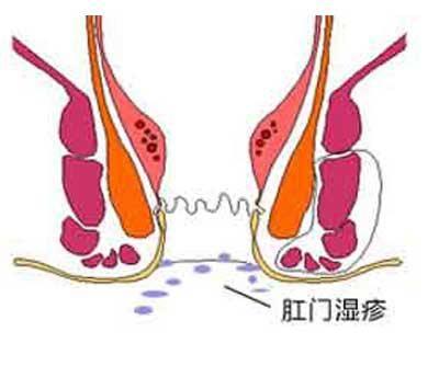 肛门湿疹真的治不好吗