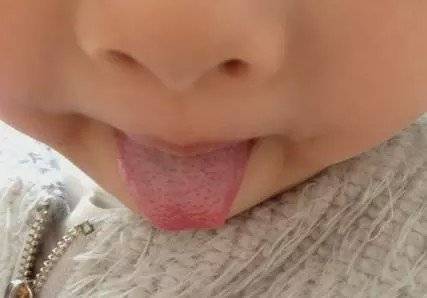 孩子|宝宝身体健康状况早知道，防患于未然！捏积派——学会舌诊