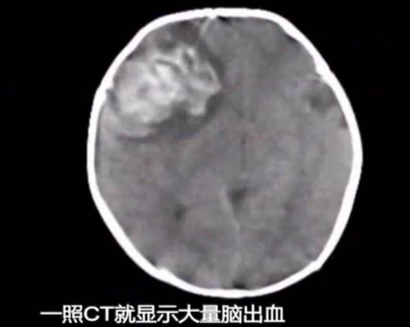 婴儿|医生：和妈妈坐月子中这个习惯有关2月龄婴儿突发脑出血