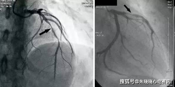 第二天上午行冠状动脉造影检查,结果如下