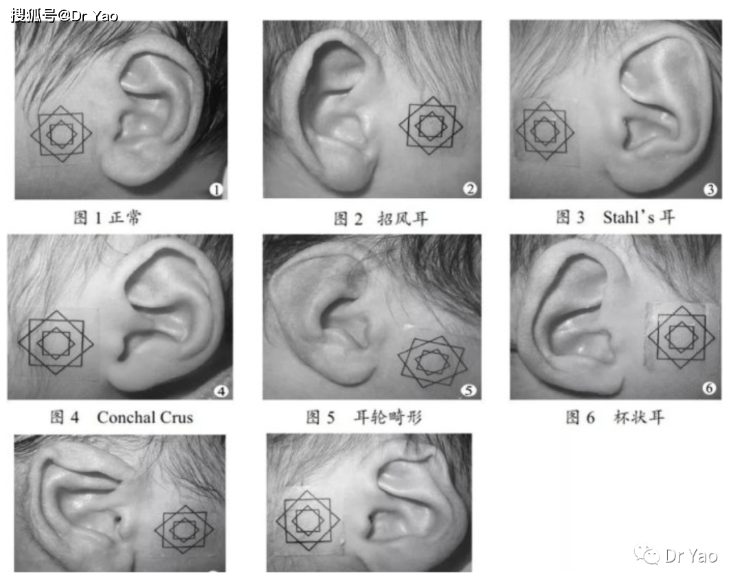 耳廓畸形越早治疗效果越好