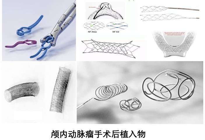 颅内动脉瘤术后能做磁共振检查吗?