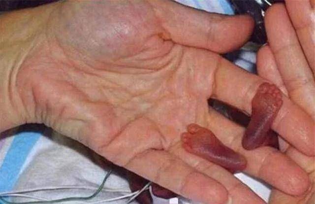 阿米|现状让很多人“失望”了还记得世界上最小的婴儿吗？14年过去了