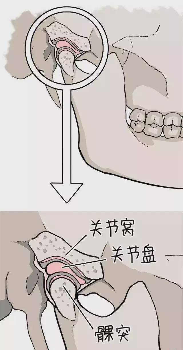 打哈欠下巴就弹响吃东西下颌疼痛你是颞下颌关节紊乱