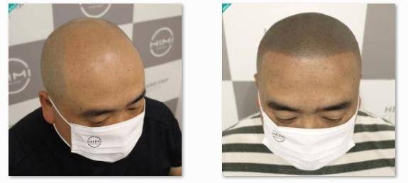 脱发严重是什么样的 ccc2d4661c7543b5a3bd4f3a507d91a6.jpeg