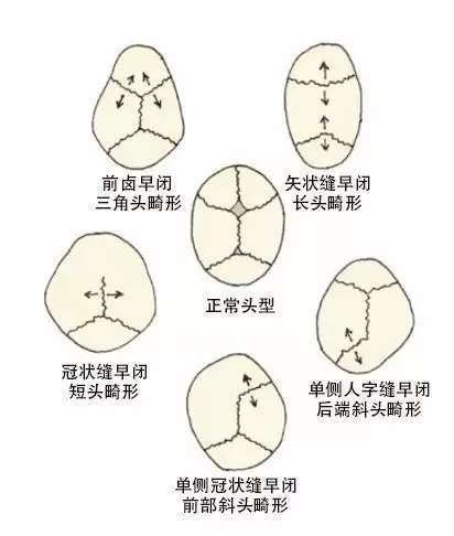 三月时父母再次带孩子到当地医院就诊,发现患儿双侧冠状缝完