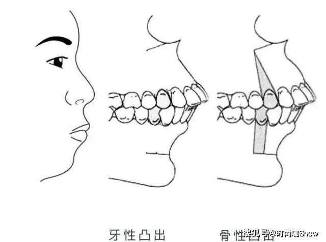 嘴巴太翘怎么办