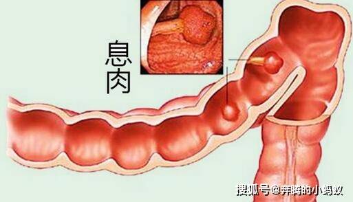 直肠多发性肉息怎么办