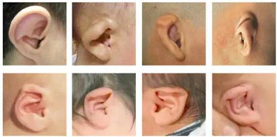 关于耳廓畸形，这几种耳形一定要引起重视！