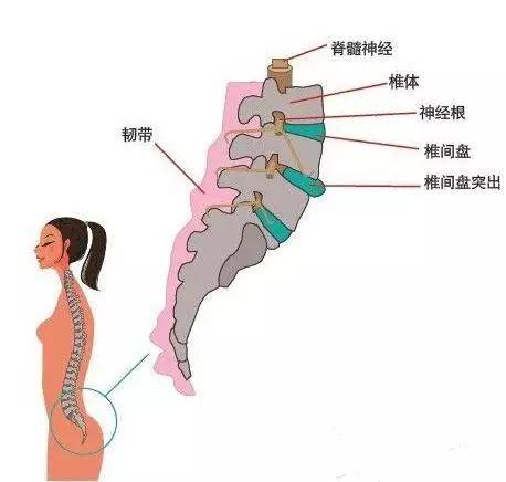 腰椎间盘突出患者向正后方突出的髓核或脱垂,游离椎间盘组织压迫马尾