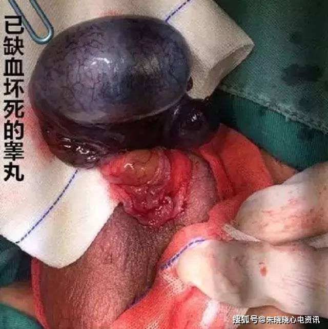 10岁男孩痛失"蛋蛋"!医生的话更"痛"!_睾丸
