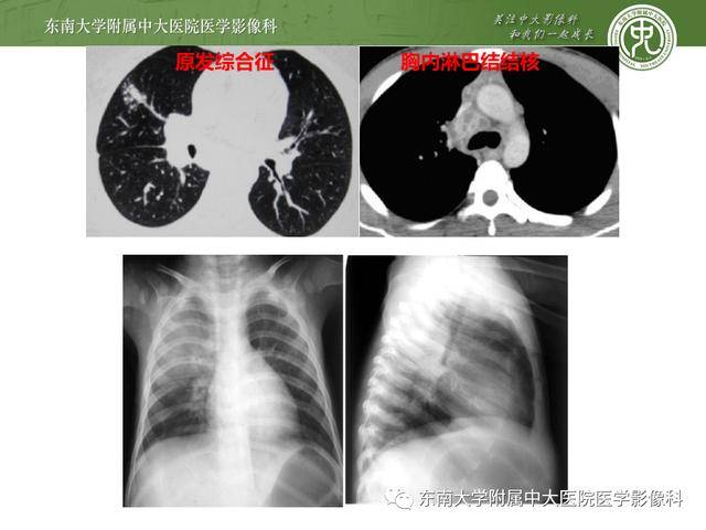 肺结核影像鉴别与表现