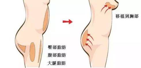 如何快速瘦下胸部脂肪 71869b0fdd5d456c9bba1fc4b2402b44.jpeg