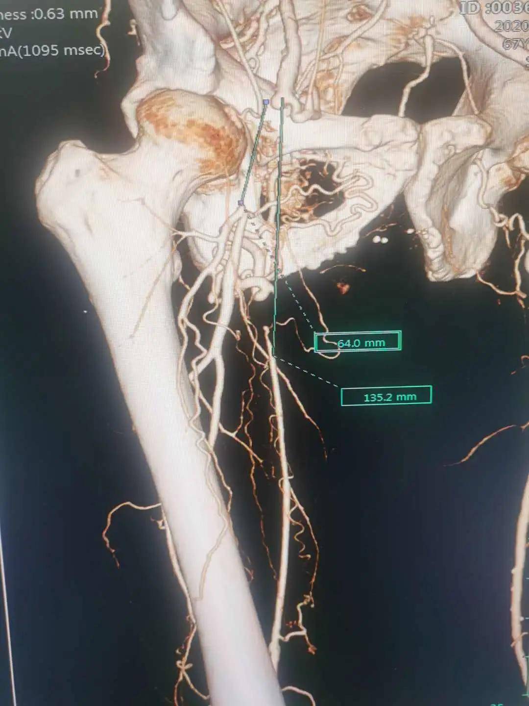 右股动脉血管疏通复合手术内外联动威海高区利民医院