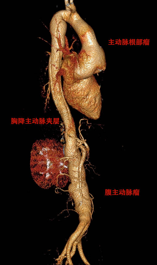 成都市第三人民医院多学科通力合作,完成"全胸腹主动脉替换术"