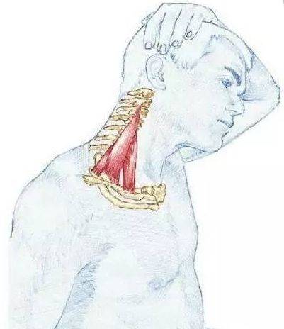胸闷气短手臂疼痛麻木的元凶斜角肌