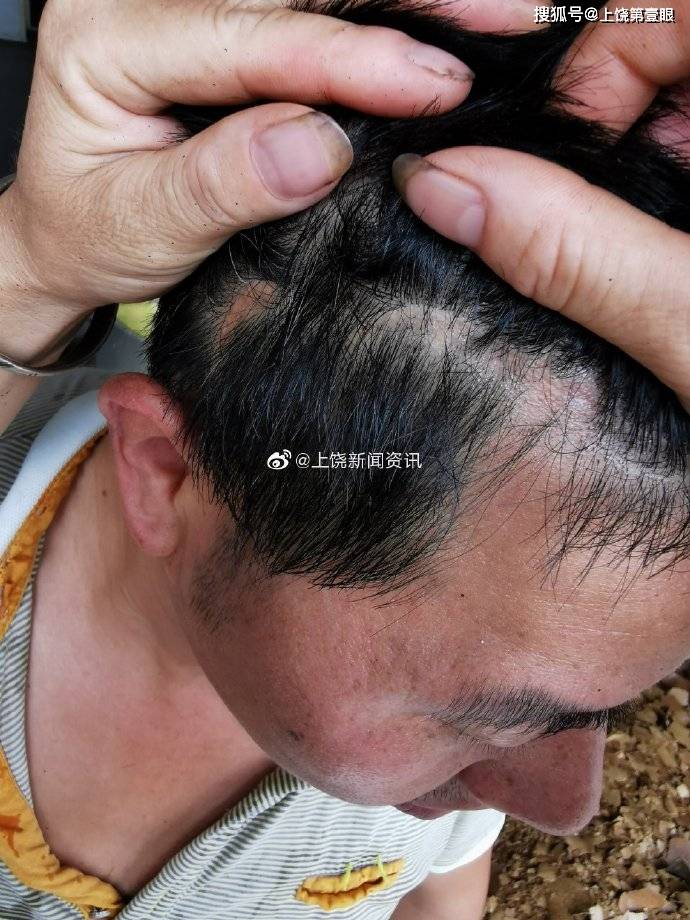 颅骨|上饶吕来清:交通事故致颅骨破碎花16万 开榨油店供两个儿子读书七年未修补