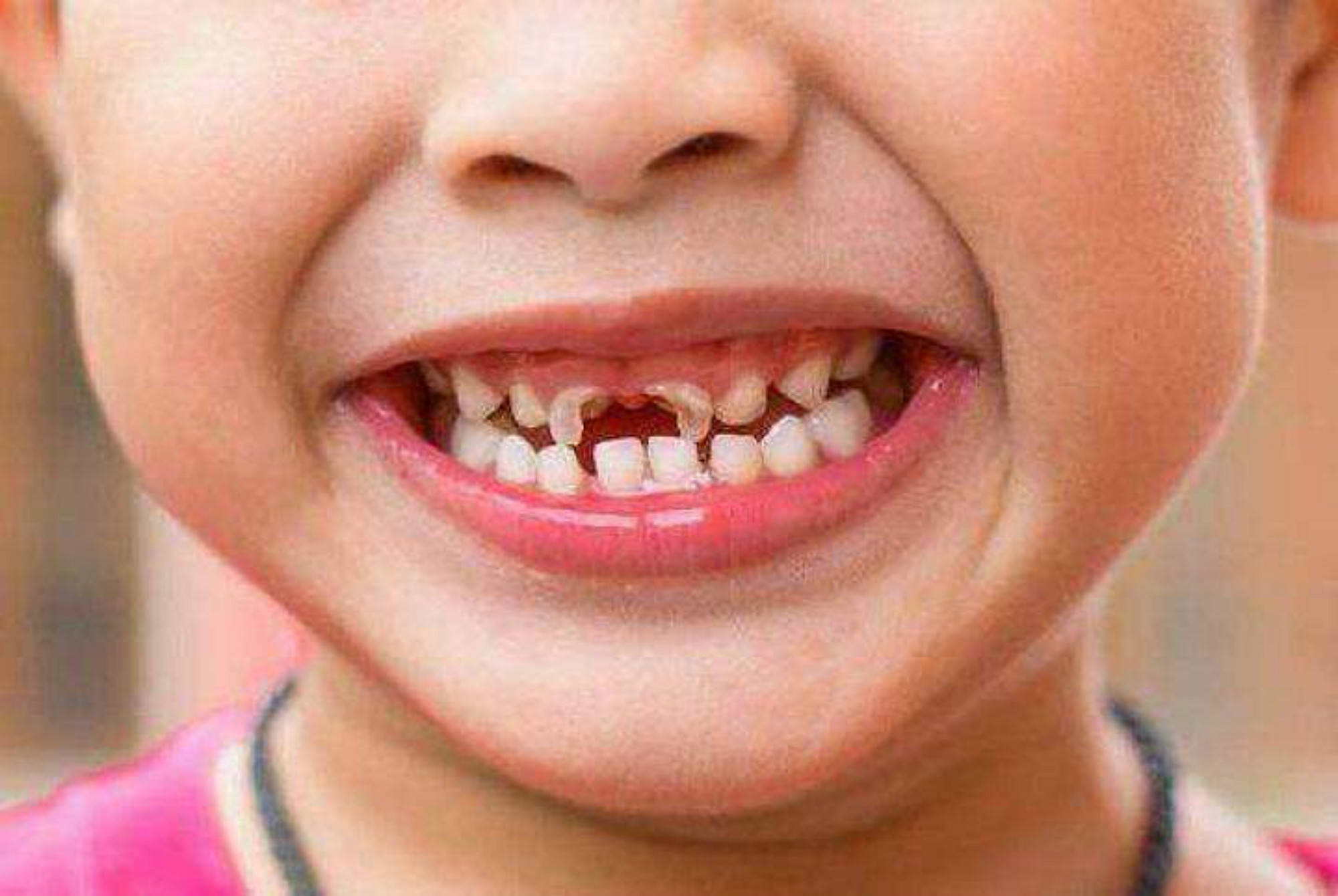 孩子两岁后还没戒奶瓶,伤害的不仅仅是牙齿,一点不夸张事实如此