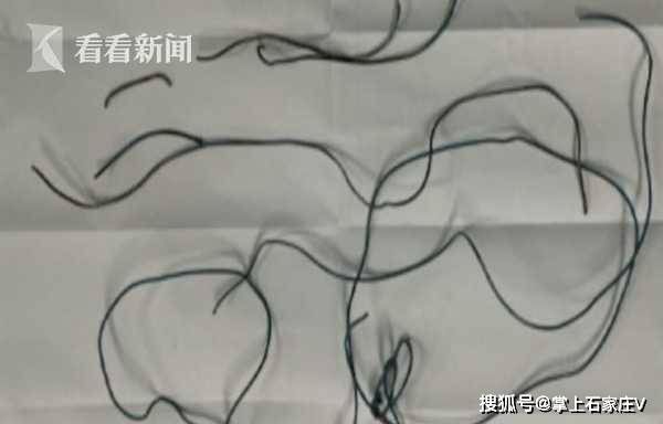 豆豆|5年前就塞入尿道！10岁男孩膀胱内取出1.5米电线