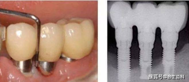 种植牙寿命到了怎么办?——合生齿科dr.王强