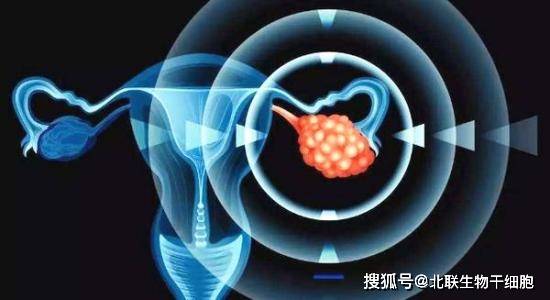 北联生物凤血干细胞治疗卵巢早衰