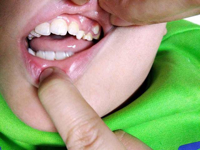6岁孩子长出“双排牙”，父母爱孩子的行为，却变成了“害”孩子