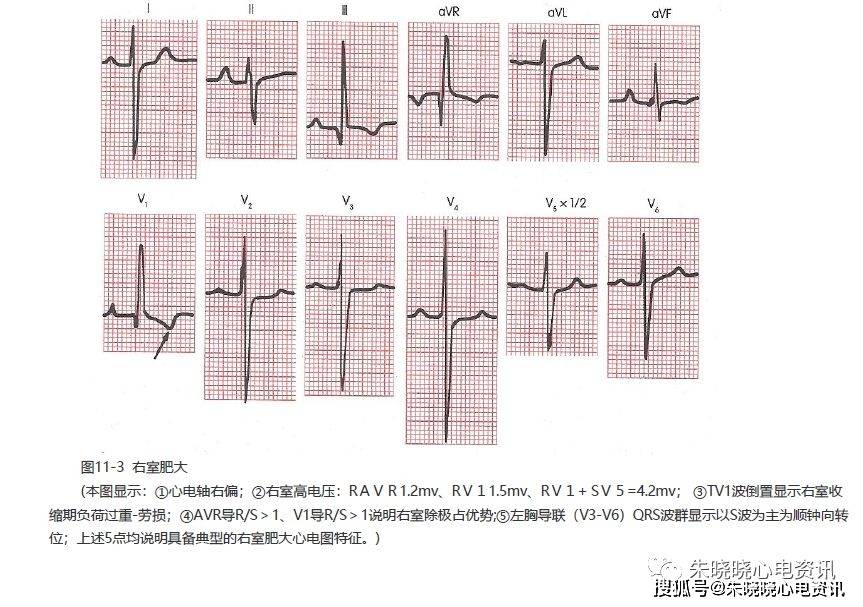 第十一讲:右室肥大及双室肥大