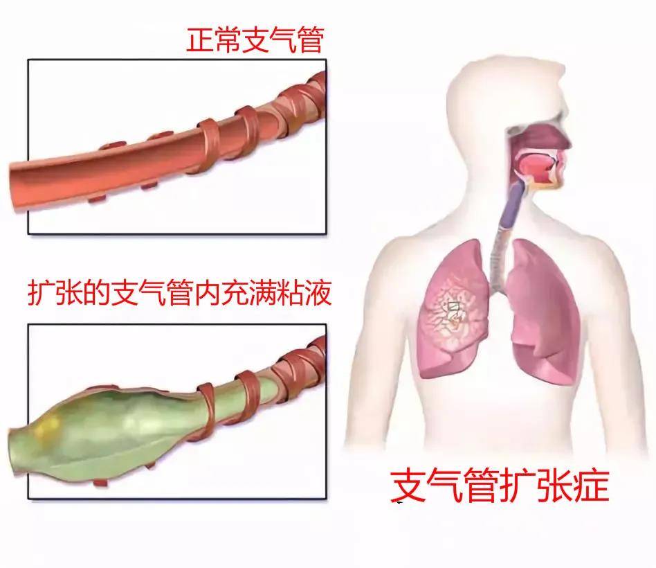 成都支气管扩张在日常生活中应该注意些什么