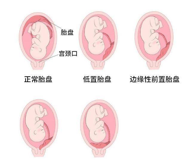 前壁胎盘,前置胎盘……关于胎盘的术语你读懂了吗?