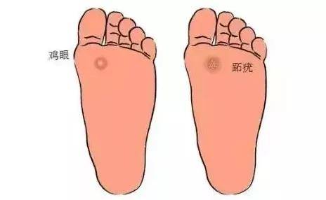 跖疣